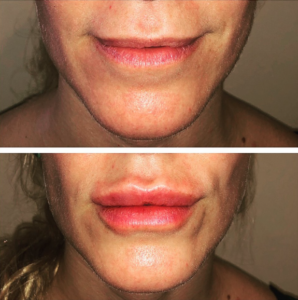 aumento de labios