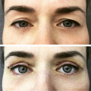 blefaroplastia